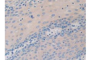 DAB staining on IHC-P; Samples: Human Stomach cancer Tissue (nectin-3 antibody  (AA 171-377))