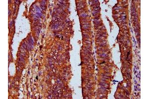 IHC image of ABIN7167644 diluted at 1:500 and staining in paraffin-embedded human colon cancer performed on a Leica BondTM system. (UPF3B antibody  (AA 319-423))