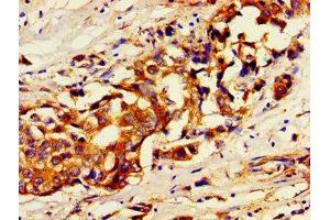 Immunohistochemistry of paraffin-embedded human breast cancer using ABIN7174356 at dilution of 1:100 (USP7 antibody  (C-Term))