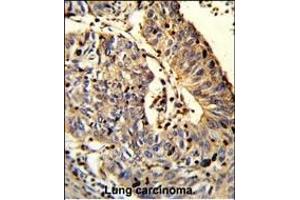 Formalin-fixed and paraffin-embedded human Lung carcinoma reacted with C21orf29 Antibody (Center), which was peroxidase-conjugated to the secondary antibody, followed by DAB staining. (TSPEAR antibody  (AA 293-320))