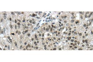 Immunohistochemistry of paraffin-embedded Human breast cancer using TRIM24 Polyclonal Antibody at dilution of 1/40 (TRIM24 antibody)