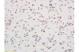 Formalin-fixed and paraffin embedded human glioma labeled with Rabbit Anti DATF1/IDO1 Polyclonal Antibody, Unconjugated  at 1:200 followed by conjugation to the secondary antibody and DAB staining (IDO1 antibody  (AA 1-100))
