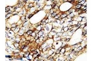 IHC-P: FGF1 antibody testing of human breast cancer tissue (FGF1 antibody  (AA 16-155))