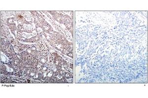 Immunohistochemical analysis of paraffin-embedded human breast carcinoma tissue using NFKBIB (phospho S23) polyclonal antibody . (NFKBIB antibody  (pSer23))