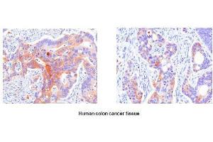 Paraffin embedded sections of human colon canitrocelluloseer tissue were initrocelluloseubated with anti-human Hsp27 (1:50) for 2 hours at room temperature. (HSP27 antibody  (AA 1-205))
