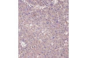 Immunohistochemical analysis of A on paraffin-embedded Human hepato carcinoma tissue. (PRKG1 antibody  (C-Term))