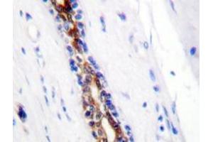 Immunohistochemistry analyzes of IRAK1 antibody in paraffin-embedded human breast carcinoma tissue. (IRAK1 antibody)
