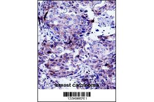 CTTN Antibody immunohistochemistry analysis in formalin fixed and paraffin embedded human breast carcinoma followed by peroxidase conjugation of the secondary antibody and DAB staining. (Cortactin antibody  (AA 273-302))