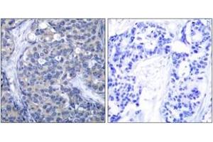 Immunohistochemistry analysis of paraffin-embedded human breast carcinoma tissue, using ZAP-70 (Ab-319) Antibody. (ZAP70 antibody  (AA 286-335))