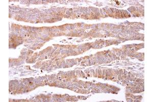 IHC-P Image ILBP antibody detects ILBP protein at cytosol on human colon carcinoma by immunohistochemical analysis. (FABP6 antibody)