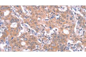 Immunohistochemistry of paraffin-embedded Human gastric cancer using GABAA Receptor alpha1 Polyclonal Antibody at dilution of 1:30 (GABRA1 antibody)