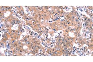 Immunohistochemistry of paraffin-embedded Human gastric cancer using GABAA Receptor alpha1 Polyclonal Antibody at dilution of 1:30