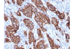 Formalin-fixed, paraffin-embedded human Breast Carcinoma stained with HER-2 Monospecific Mouse Monoclonal Antibody (ERBB2/3093). (ErbB2/Her2 antibody  (AA 311-462))