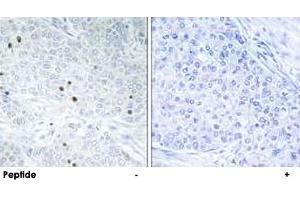 Immunohistochemistry analysis of paraffin-embedded human breast carcinoma tissue, using TP53INP2 polyclonal antibody .