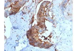 Formalin-fixed, paraffin-embedded human Renal Cell Carcinoma stained with Cathepsin D Mouse Monoclonal Antibody (CTSD/2781). (Cathepsin D antibody  (AA 104-250))