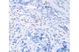 IHC-P analysis of Human Rectum Cancer Tissue, with DAB staining. (MUC2 antibody  (AA 5075-5179))