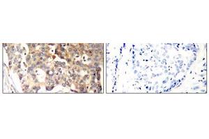 Immunohistochemical analysis of paraffin-embedded human breast carcinoma tissue, using SHP-1 (Ab-536) antibody (E021318). (SHP1 antibody)