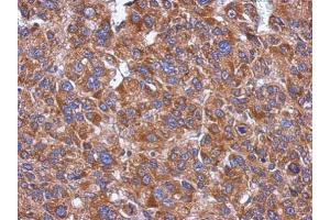 IHC-P Image Immunohistochemical analysis of paraffin-embedded human hepatoma, using CYP26A1 , antibody at 1:500 dilution. (CYP26A1 antibody  (Center))