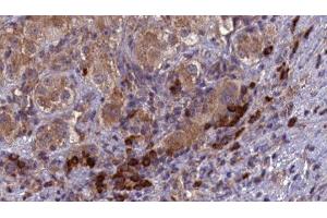 ABIN6277103 at 1/100 staining Human liver cancer tissue by IHC-P. (SPAM1 antibody  (Internal Region))
