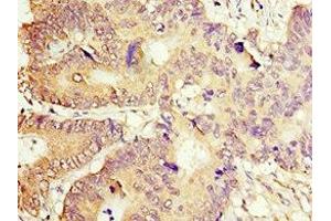 Immunohistochemistry of paraffin-embedded human colon cancer using ABIN7149378 at dilution of 1:100 (ACOT7 antibody  (AA 151-380))