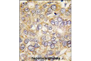 Formalin-fixed and paraffin-embedded human hepatocellular carcinoma reacted with CHRD polyclonal antibody  , which was peroxidase-conjugated to the secondary antibody, followed by DAB staining.