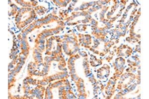 The image on the left is immunohistochemistry of paraffin-embedded Human thyroid cancer tissue using ABIN7192286(SCNN1A Antibody) at dilution 1/30, on the right is treated with synthetic peptide. (SCNN1A antibody)