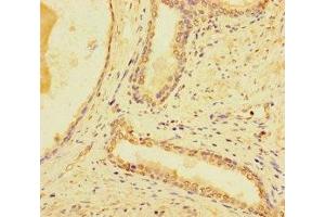 Immunohistochemistry of paraffin-embedded human prostate cancer using ABIN7171154 at dilution of 1:100 (SYT1 antibody  (AA 301-523))
