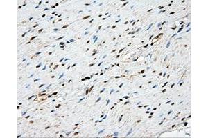 Immunohistochemical staining of paraffin-embedded Adenocarcinoma of ovary tissue using anti-NME4 mouse monoclonal antibody. (NME4 antibody)