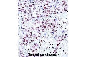 NCK1 Antibody (N-term) (ABIN657648 and ABIN2846643) immunohistochemistry analysis in formalin fixed and paraffin embedded human breast carcinoma followed by peroxidase conjugation of the secondary antibody and DAB staining. (NCK1 antibody  (N-Term))