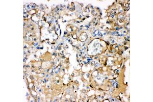 Anti- KCNMA1antibody,IHC(P) IHC(P): Human Lung Cancer Tissue (KCNMA1 antibody  (AA 124-467))