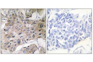 Immunohistochemistry analysis of paraffin-embedded human breast carcinoma tissue using COX7S/A2 antibody. (COX7S/A2 (N-Term) antibody)