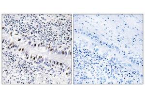 Immunohistochemistry analysis of paraffin-embedded human lung carcinoma tissue, using ZNF76 antibody. (ZNF76 antibody  (Internal Region))