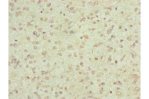 Immunohistochemistry of paraffin-embedded human glioma using ABIN7152447 at dilution of 1:100 (FBXO6 antibody  (AA 104-293))