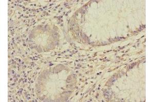 Immunohistochemistry of paraffin-embedded human colon cancer using ABIN7170966 at dilution of 1:100 (SAE1 antibody  (AA 1-346))