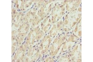 Immunohistochemistry of paraffin-embedded human gastric cancer using ABIN7151422 at dilution of 1:100