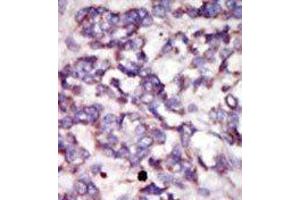 Formalin-fixed and paraffin-embedded human cancer tissue reacted with the primary antibody, which was peroxidase-conjugated to the secondary antibody, followed by DAB staining. (PDK2 antibody  (C-Term))