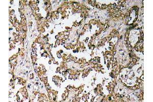 Immunohistochemical analysis of paraffin-embedded human lung cancer tissue using OR5H15 polyclonal antibody .