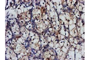 Immunohistochemical staining of paraffin-embedded Carcinoma of Human kidney tissue using anti-MGLL mouse monoclonal antibody. (MGLL antibody)
