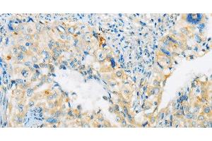 Immunohistochemistry of paraffin-embedded Human cervical cancer tissue using ARHGEF10 Polyclonal Antibody at dilution 1:45 (ARHGEF10 antibody)