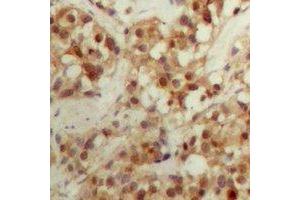 Immunohistochemical analysis of CBFB staining in human breast cancer formalin fixed paraffin embedded tissue section. (CBFB antibody  (N-Term))