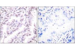 Immunohistochemistry analysis of paraffin-embedded human lung carcinoma tissue, using Ku80 (Ab-714) Antibody. (XRCC5 antibody  (AA 683-732))