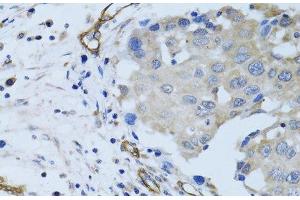 Immunohistochemistry of paraffin-embedded Human breast cancer using MCAM Polyclonal Antibody at dilution of 1:100 (40x lens).