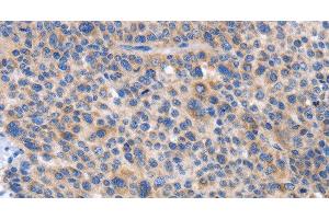 Immunohistochemistry of paraffin-embedded Human liver cancer tissue using CARD17 Polyclonal Antibody at dilution 1:50
