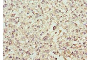 Immunohistochemistry of paraffin-embedded human melanoma using ABIN7143939 at dilution of 1:100 (SNCA antibody  (AA 1-139))