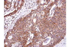 IHC-P Image ETBR antibody [N1N2], N-term detects ETBR protein at cytosol on human colon carcinoma by immunohistochemical analysis. (EDNRB antibody  (N-Term))