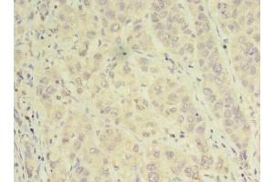 Immunohistochemistry of paraffin-embedded human liver cancer using ABIN7143935 at dilution of 1:100 (NAPA antibody  (AA 1-295))