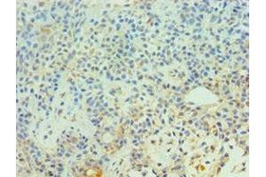 Immunohistochemistry of paraffin-embedded human breast cancer using ABIN7147302 at dilution of 1:100 (CDC16 antibody  (AA 371-620))