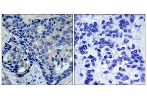 Immunohistochemical analysis of paraffin-embedded human breast carcinoma tissue using Pyk2(Phospho-Tyr402) Antibody(left) or the same antibody preincubated with blocking peptide(right). (PTK2B antibody  (pTyr402))