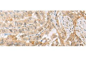 Immunohistochemistry of paraffin-embedded Human thyroid cancer tissue using HBZ Polyclonal Antibody at dilution of 1:120(x200) (HBZ antibody)