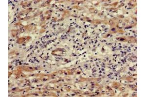 Immunohistochemistry of paraffin-embedded human liver cancer using ABIN7175730 at dilution of 1:100 (WDR19 antibody  (AA 45-226))